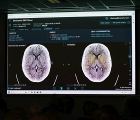 Týden mozku AV ČR na Ostravské univerzitě: Možnosti umělé inteligence v analýze CT u pacientů s podezřením na cévní mozkovou příhodu 11. března 2024Autor: Tamara Masnicová